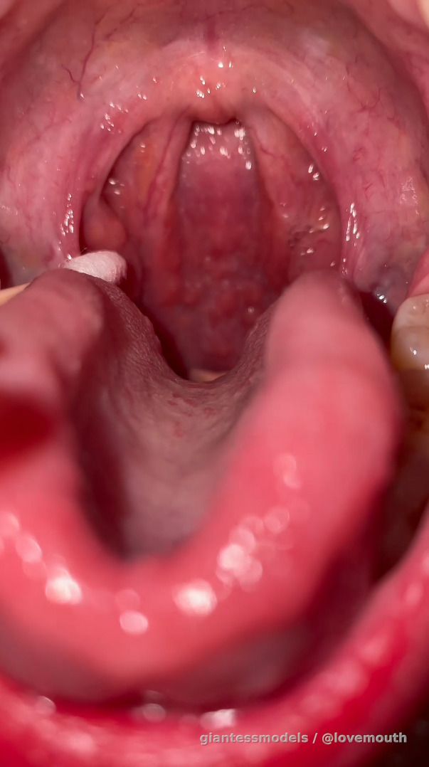 The girl gagged after using a cotton swab to poke her uvula.