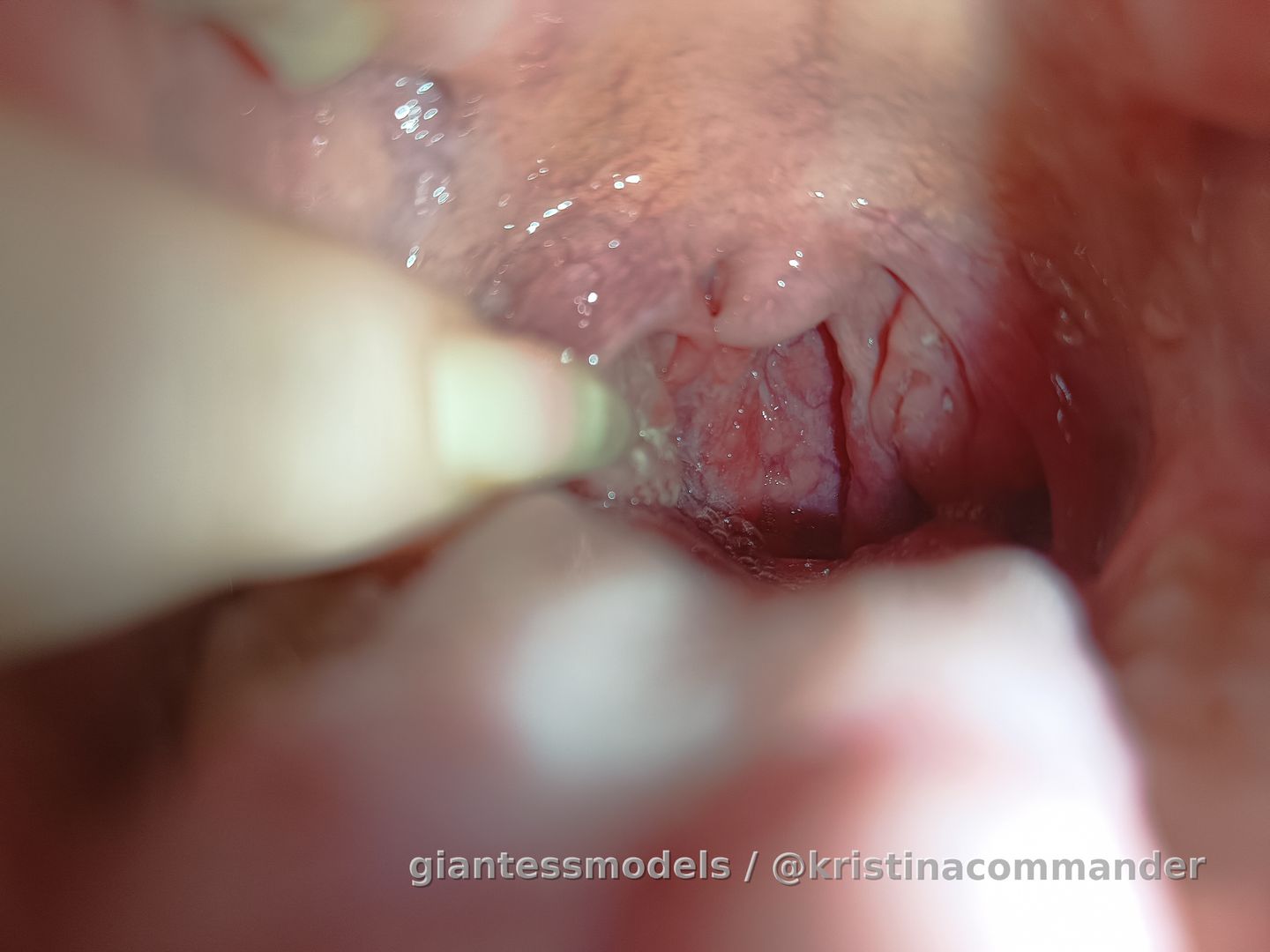 Touching purulent tonsils + sore throat (video 1 min)