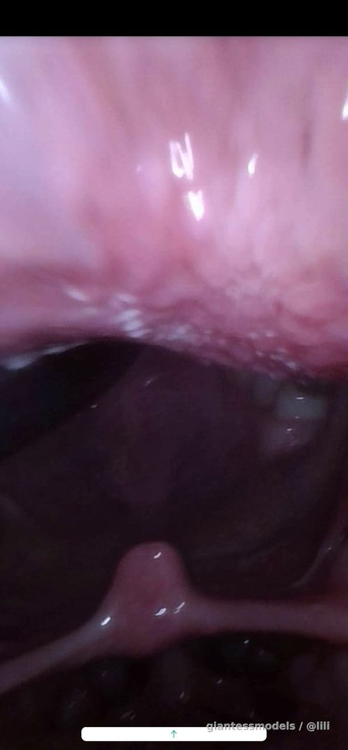 Gummy traveling into my stomach endo view