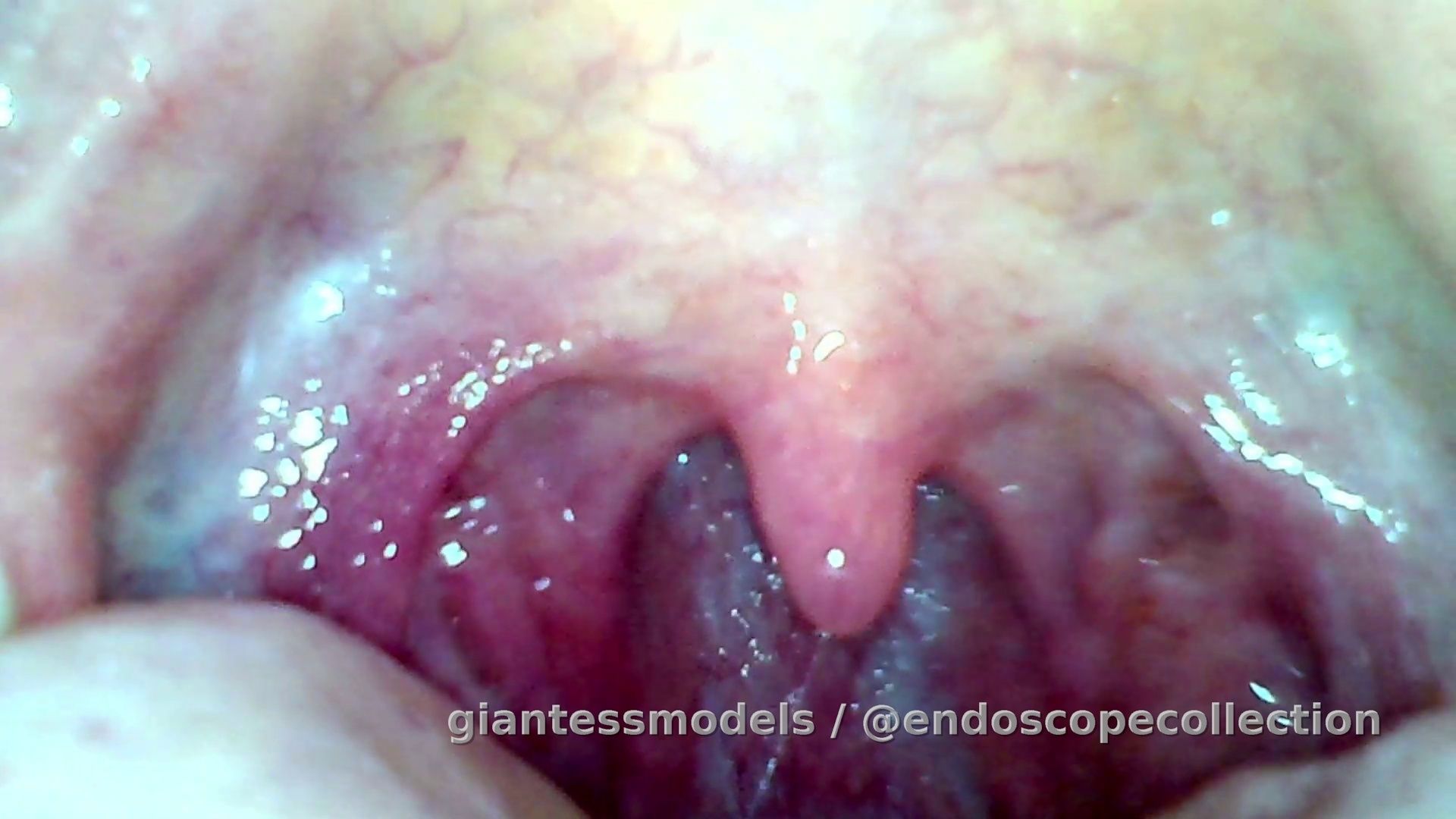 Endoscope custom