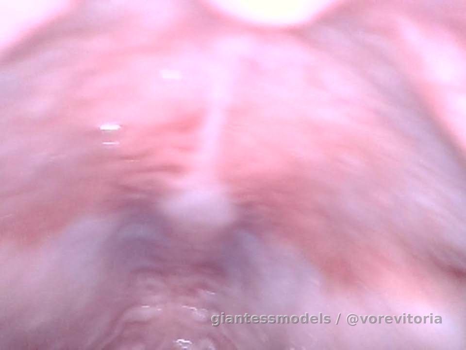 Practicing more reverse endo (: