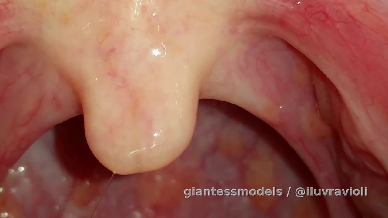 My uvula while coughing