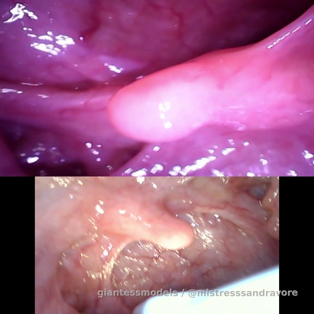 Double endoscope deep inside my mouth (:

You can see it at the same time! 