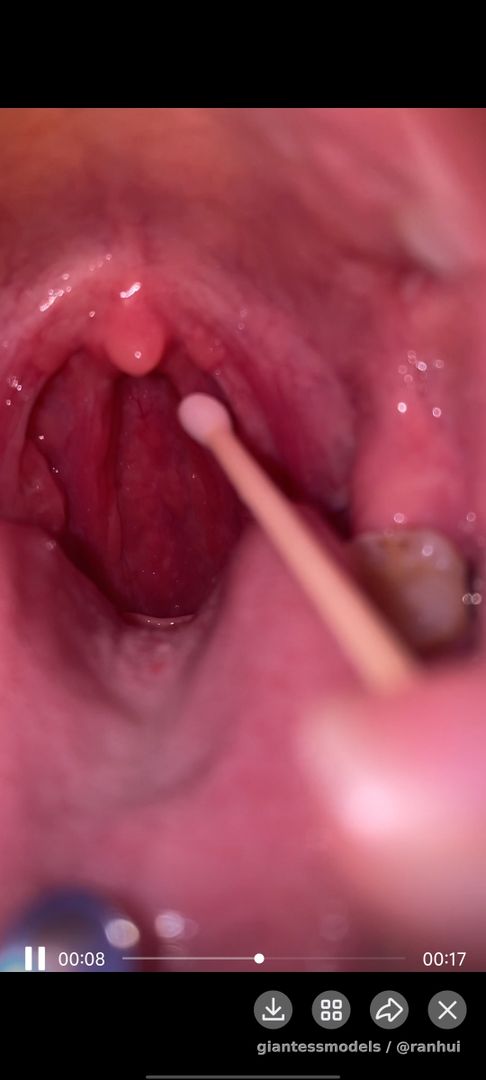 Cotton swab irritates throat and causes dry heaving