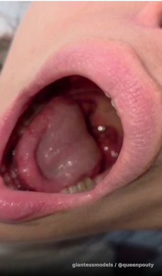UVULA & TONGSILS 👅
