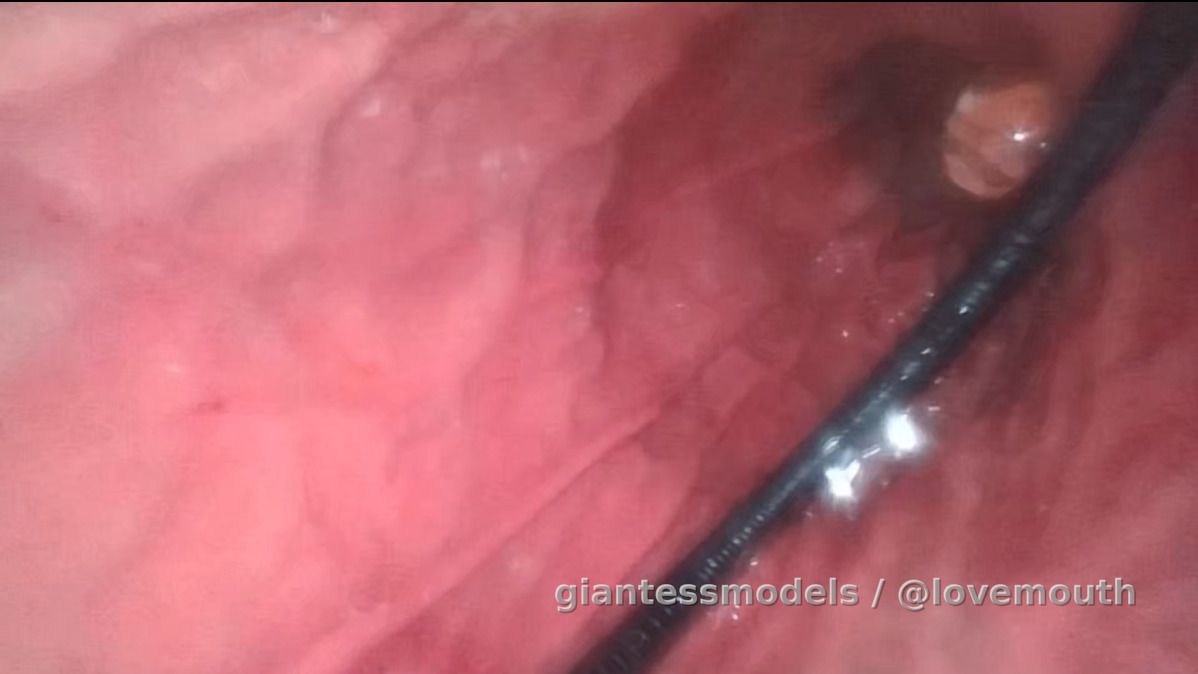 A girl uses a gastroscope to observe digestion after a meal and swallows a glass marble【1h30min】
