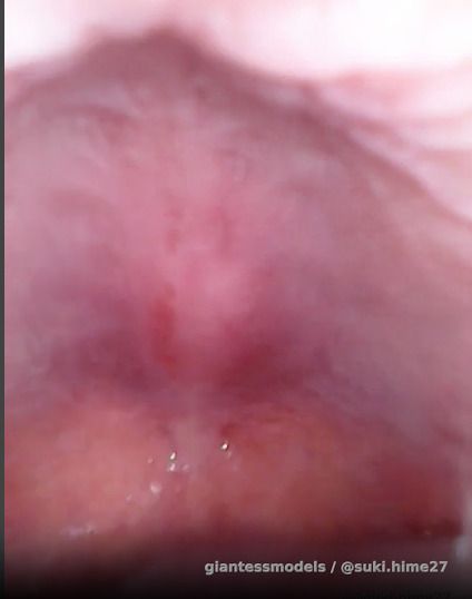 Endo fun~ uvula action