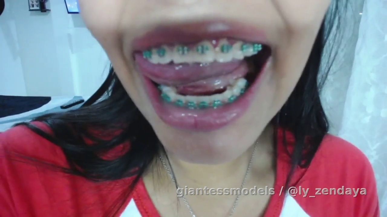 Oral Appliances Teasing Braces