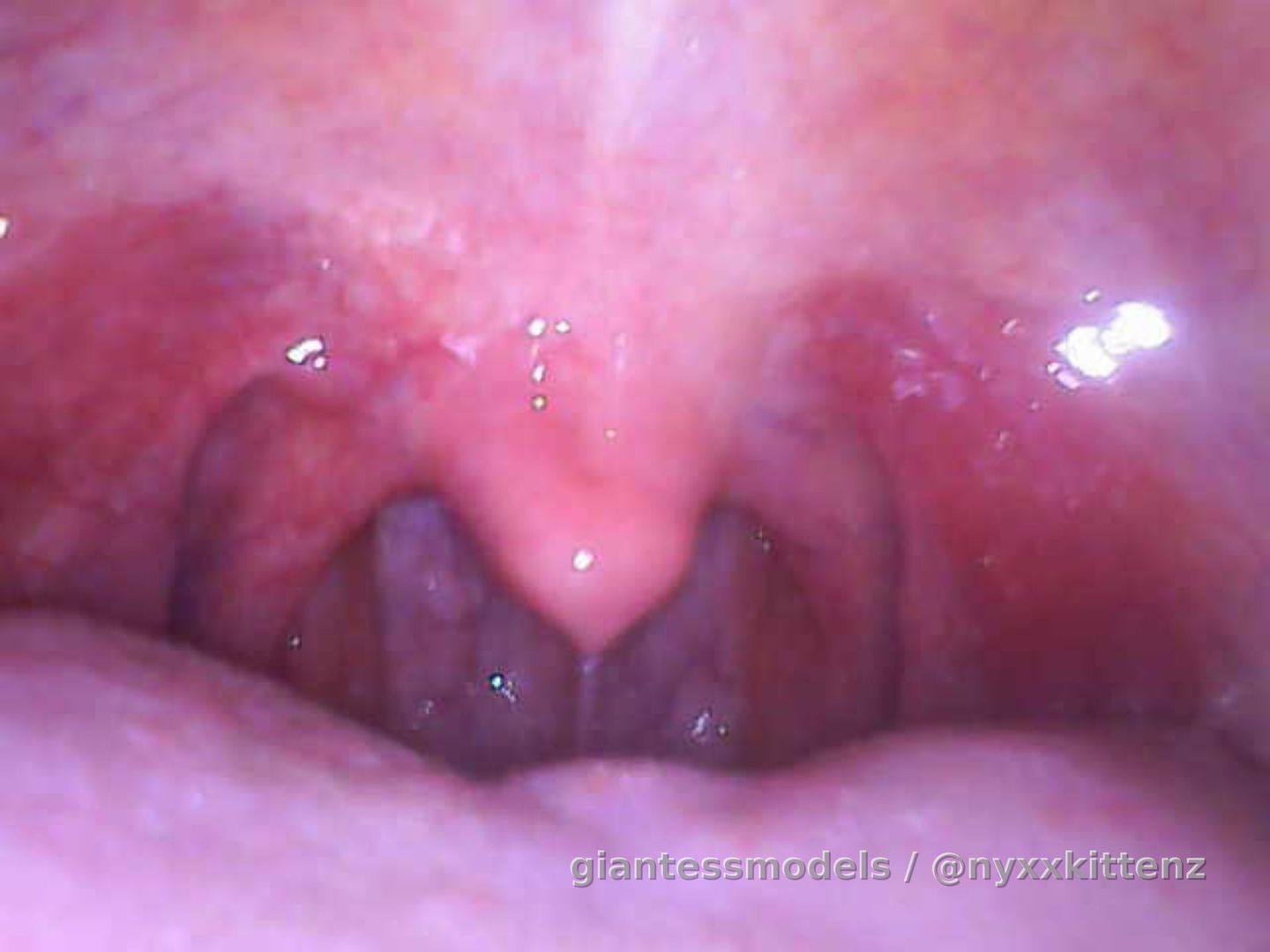 ♥️ Some endo pics of my mouth/throat and video ♥️