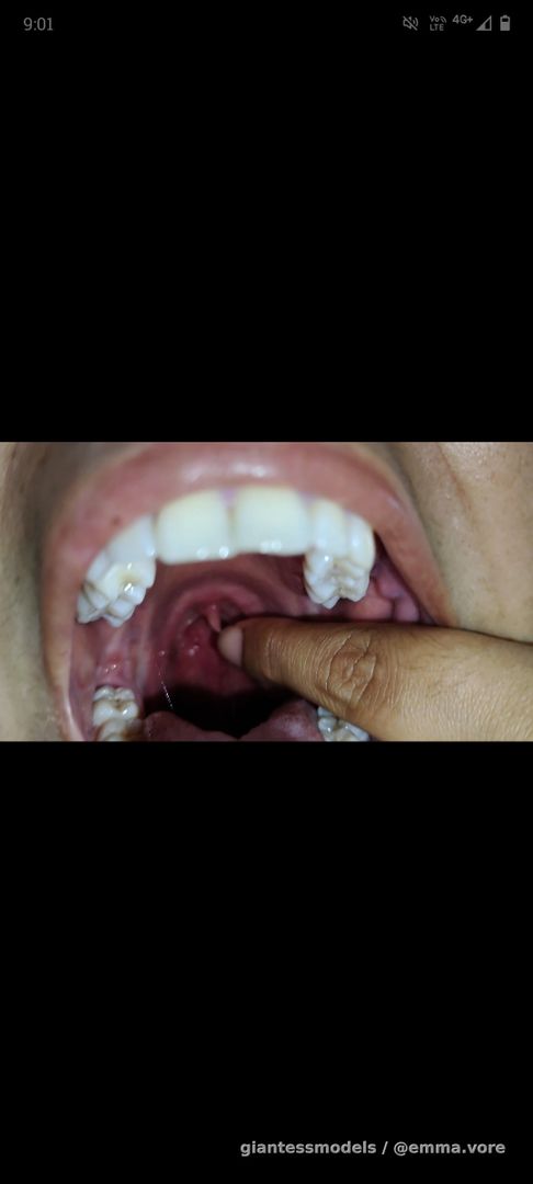 VOMITING CAUSED BY LONG UVULA 🙈🙈