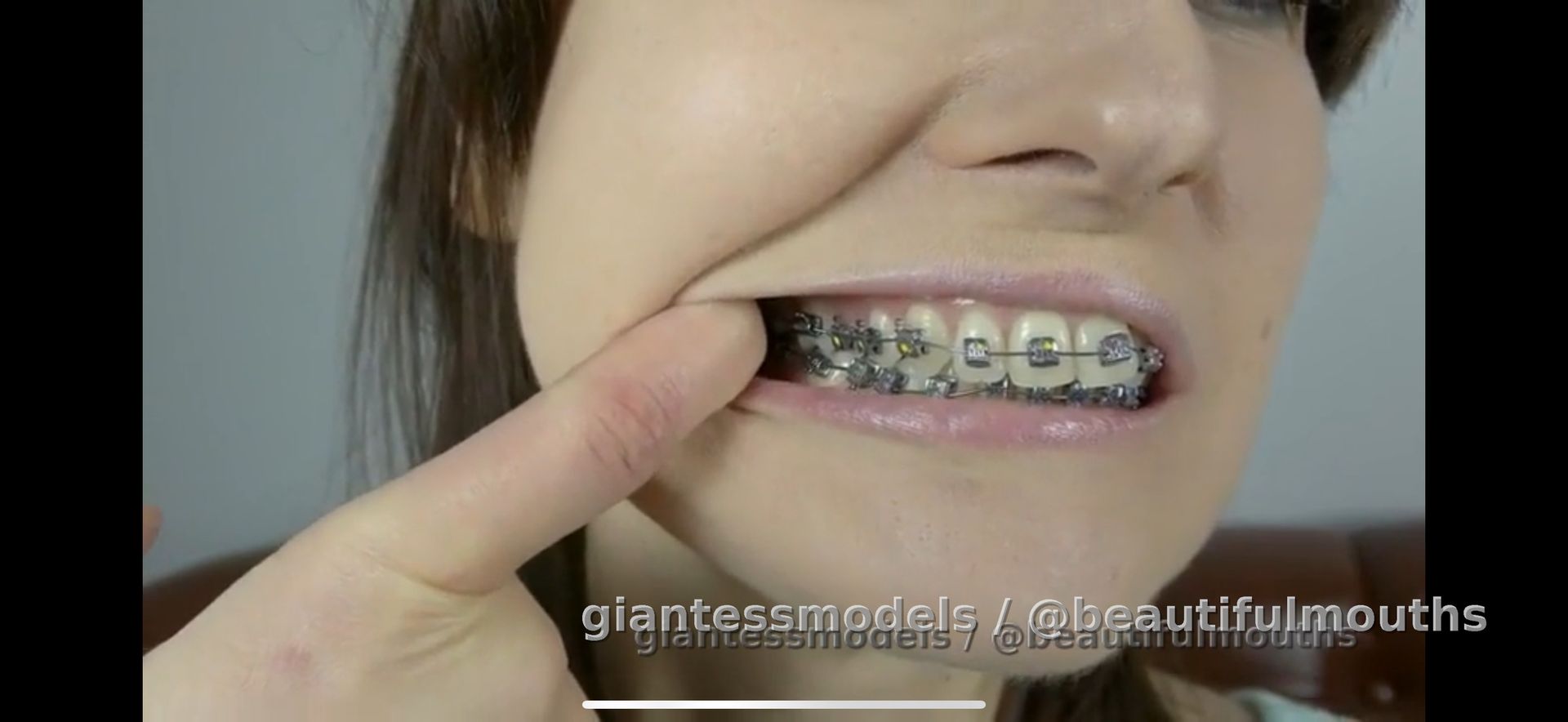 Teeth show - braces