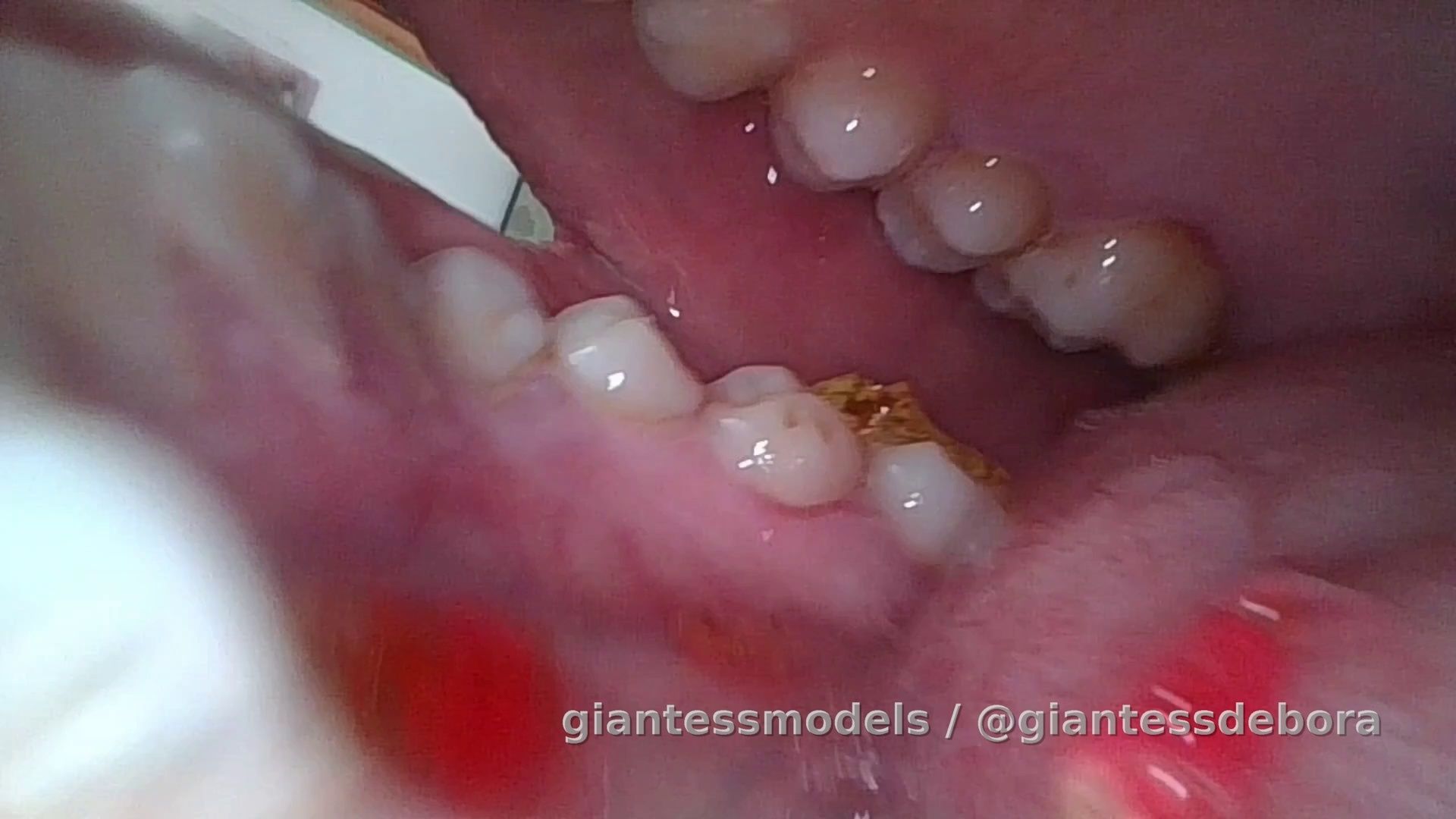 Vore close up with endoscopy