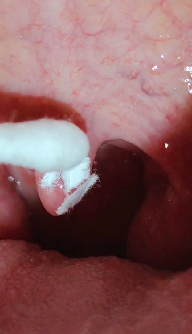 HD uvula play with paper and Q tip 