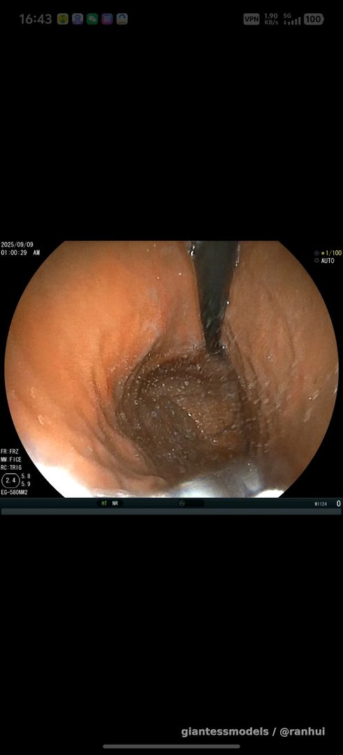 endoscope