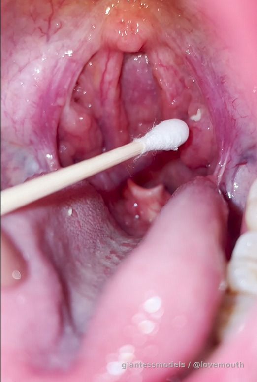 Girl's epiglottis exposed due to dry heaving