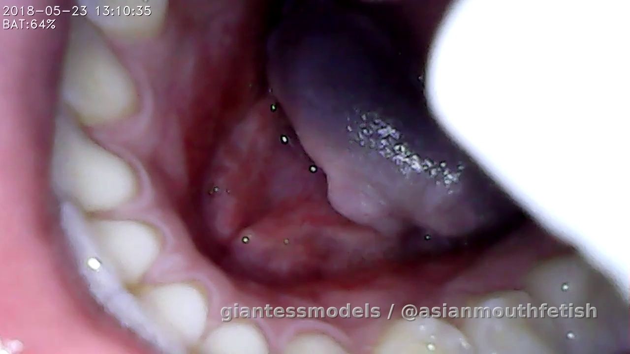 Asian giantess swallows 2 pinkies with endoscope