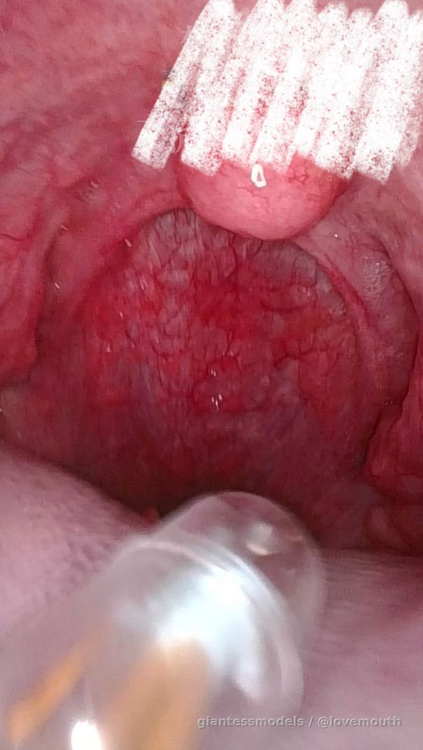 The girl swallowed the capsule and underwent gastroscopy.