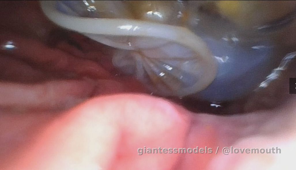 Girl swallowed condom and examined with endoscopy (before and after digestion)