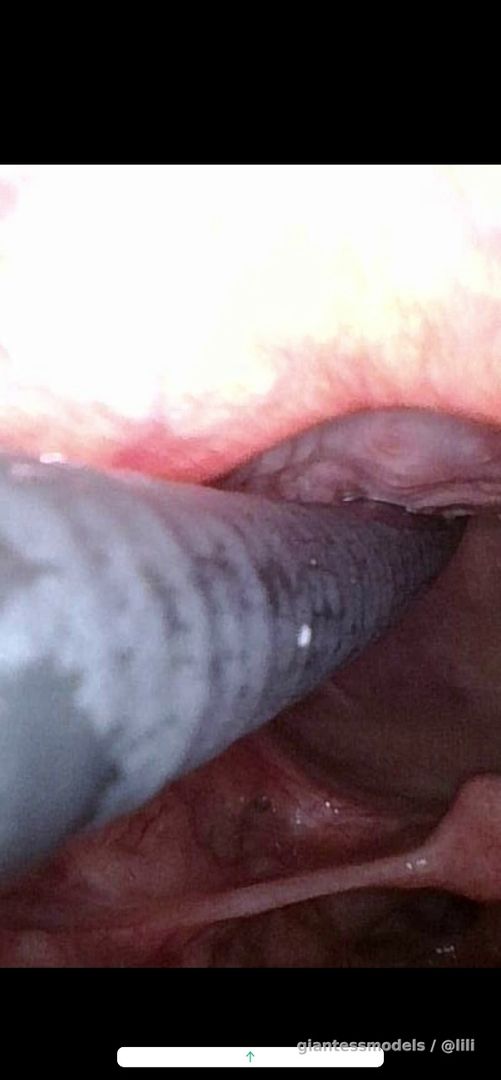 7.17内窥会厌（20min）