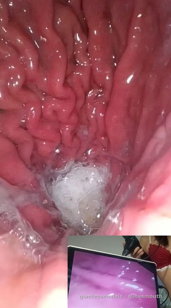A girl undergoing a gastroscopy.