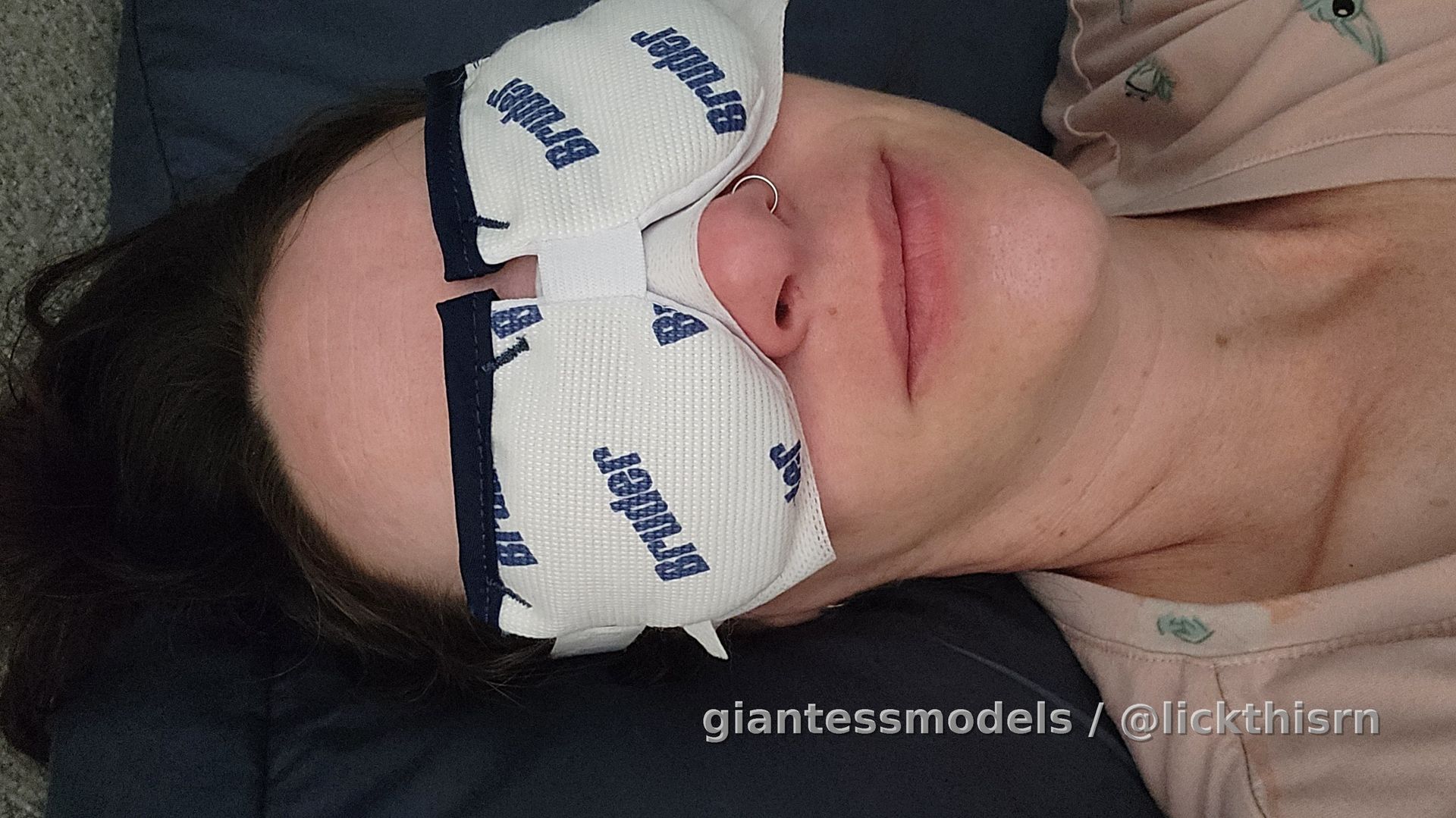 Chalazion cyst as me like....