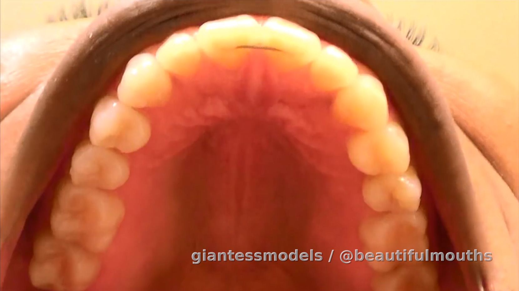 Permanent retainer