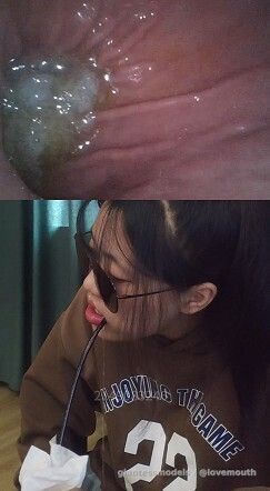 The girl underwent a gastroscopy.