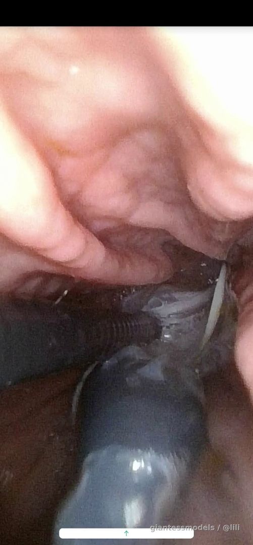 Endoscope view of condom swallowing