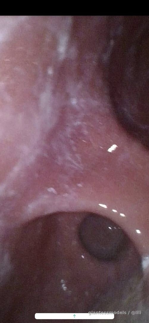 Endoscopic video after two hours of digestion. 