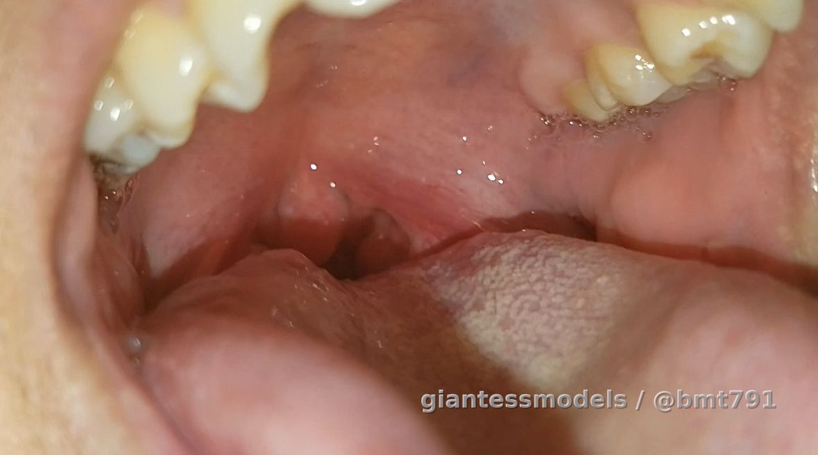 Cammie's uvula and throat 