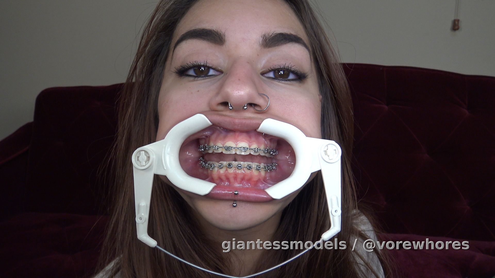 VideoWV3S – Braces with lip and cheek retractor gummy swallow – Wink wears a cheek and lip retractor and open mouth chews and swallows gummy worms. The sounds as she chews and swallows with the lip and cheek retractor in place are loud and amazing!