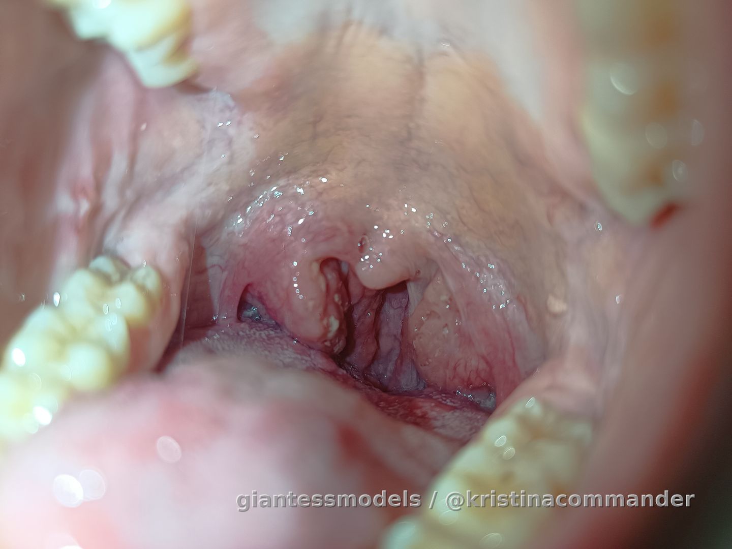 purulent tonsils + sore throat (video 1 min)