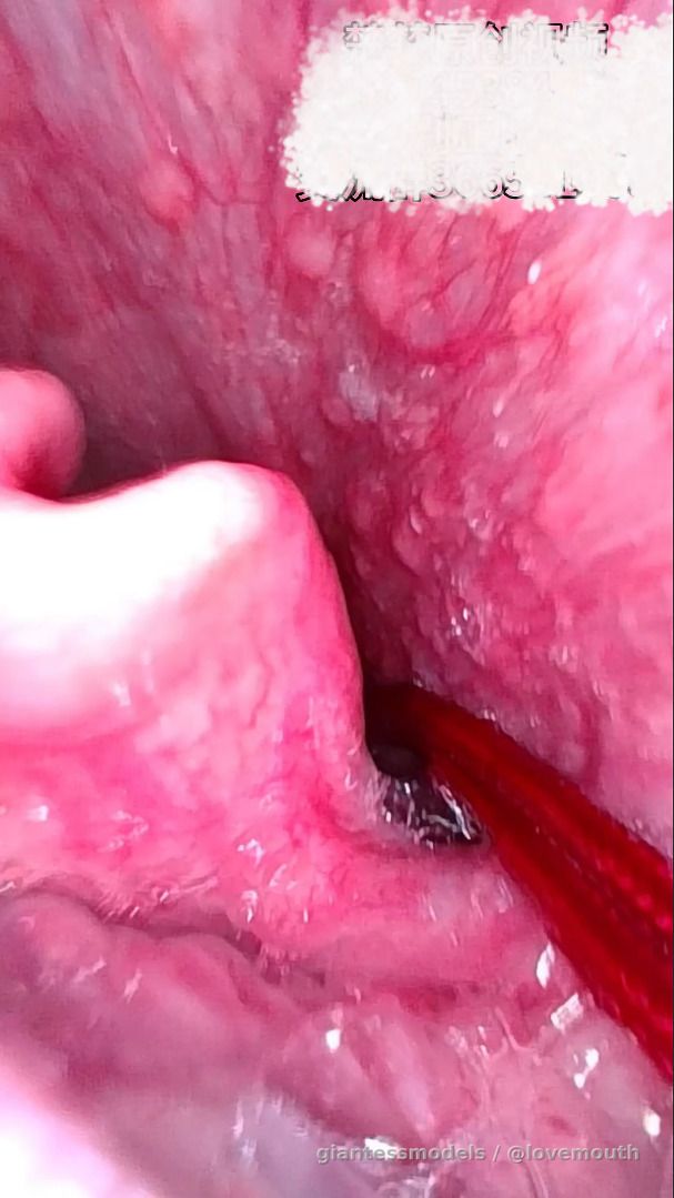 The girl swallowed a Christmas stocking and had her digestion observed with an endoscope.