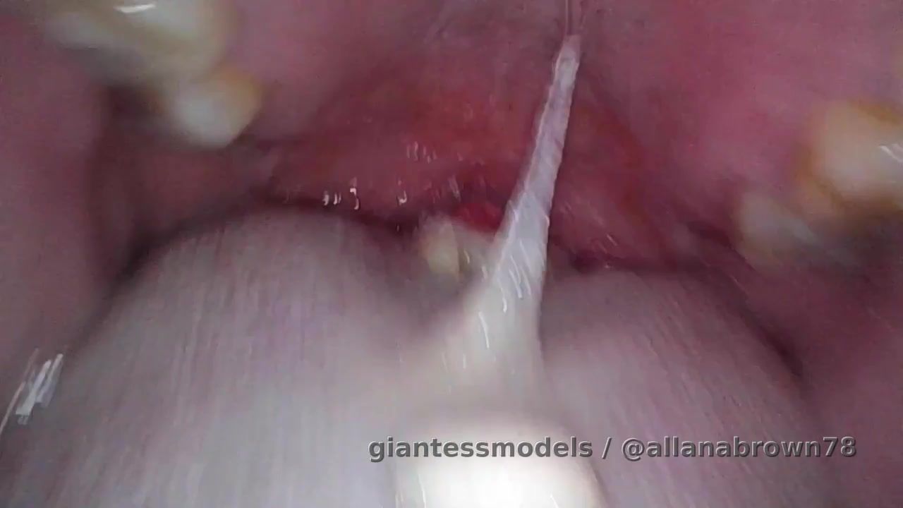 ENDOSCOPE 😜 

🤧Possible diagnosis: Acute pharyngitis/tonsillitis with inflamed tonsils, sore throat, and excessive mucus production (phlegm).

Unofficial diagnosis: My tonsils have declared war, my throat feels like sandpaper, and my body has apparently decided to produce enough phlegm to supply a small swamp. Current status: dramatic, congested, and accepting sympathy in all forms. 🤧😅