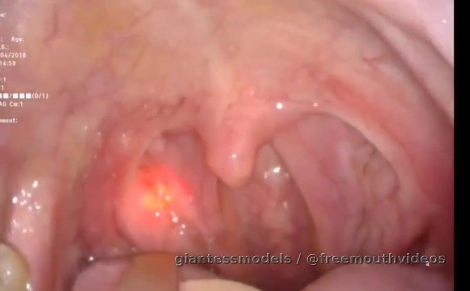 Girl Tonsil stone laser removal