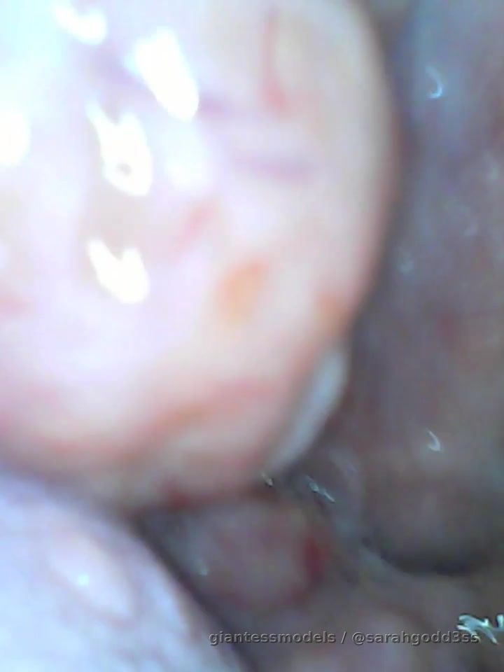 Endoscope view